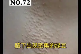 你的腋下有没有长这样绿豆大小的丘疹，那么，汗腺毛囊角化病应该怎么办？#腋窝 #腋臭 #皮肤视频封面