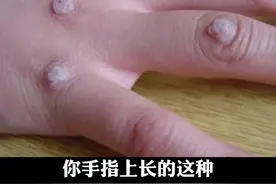 手指上长了硬疙瘩，以为是茧子？皮肤科医生提醒你这是感染了HPV #医学科普 #寻常疣 视频封面