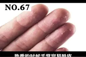 手掌脱皮起屑，特别是换季，怎么办？#剥脱性角质松解症 #手掌脱皮 视频封面