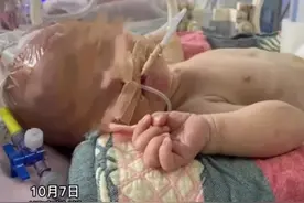 10月7日，株洲，出生仅一天的早产儿 因呼吸急促伴间断性呻吟被送医，医生：孩子没有肛门#婴儿出生第2天被查出没有肛门#呼吸急促困难视频封面