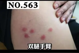 被蚊虫叮咬后起红疹，不想留下黑印这样做#丘疹性荨麻疹 #医学科普 #皮肤 视频封面