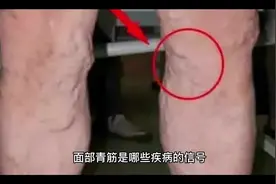 面部青筋是哪些疾病的信号#健康 #希望能帮到你 #青筋 #健康生活视频封面
