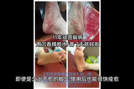 脚气如果不长在脚上你知道有多危险吗?视频封面