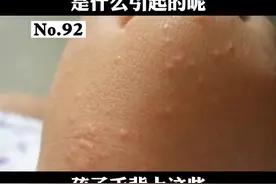 孩子手背上密密的疙瘩，有可能跟孩子经常在地上玩闹有关#沙土皮炎 #皮肤 #科普 #人类幼崽 