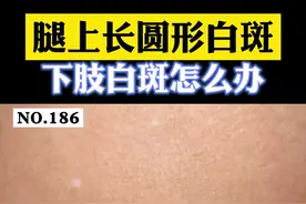 #医学科普小腿上长#白斑 ，可能是老年性白斑。#皮肤 #老年斑 视频封面