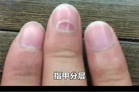 指甲分层是怎么回事？#指甲 视频封面