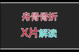 #舟骨骨折 X片解读！#医学影像 #疼痛科 #骨折视频封面