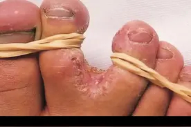 脚趾缝糜烂发白，#脚气怎么办?#科普 视频封面