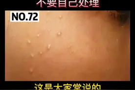 眼睛下面一颗颗脂肪粒，不要用手挤，可以这样处理#科普  #脂肪粒视频封面