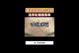 额头下巴这些小米粒，这样去处理#痘痘 #粉刺 视频封面