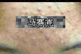 额头下巴这些小米粒，这样去处理#痘痘 #粉刺 视频封面