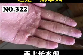 手上长水泡还大面积脱皮，非常痒，这是#鹅掌风！试试这样处理#医学科普 