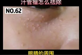 眼睛下面长这种小颗粒，挤也挤不出来，汗管瘤应该怎么办#科普 #汗管瘤 视频封面