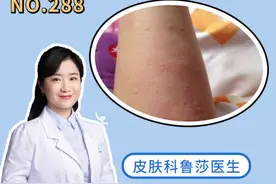 身上一热就痒，还会起红疹子，这可能是#荨麻疹 ，收好这个视频，你可能会用到#健康 #科普 #夏天 视频封面