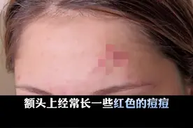 额头上长很多红色痘痘，非常苦恼，特别是留刘海之后，长得更加厉害，可以这样处理！#甲硝唑凝胶#壬二酸#医学科普 视频封面