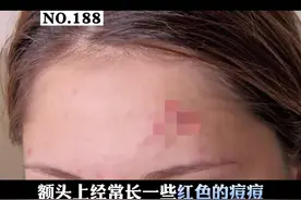 额头上长很多红色痘痘，非常苦恼，特别是留刘海之后，长得更加厉害，可以这样处理！#甲硝唑凝胶#壬二酸#医学科普 视频封面