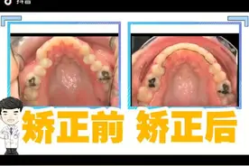 上颌突出 矫正前后对比效果#牙齿矫正视频封面