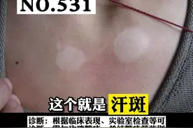 身上出现白色或者褐色的斑块，#汗斑 可以这样处理 #科普 #皮肤 视频封面