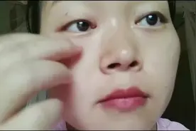 眼角长了1个脂肪粒，一女子居然自己用针给挑了！！视频封面