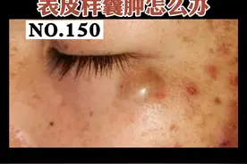 脸上长一个像痘痘一样的大包，不要去挤它，可以这么处理。#粉瘤 #表皮样囊肿 #皮脂腺囊肿 视频封面