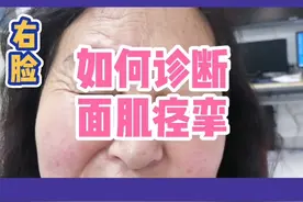 眼皮跳，嘴角抽可不是小事情，可能是面肌痉挛！得治！#面肌痉挛视频封面