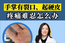 #皮肤健康手掌起硬皮，有裂口，到了冬天疼痛难忍，#鹅掌风 可以这样处理。#手癣 #手脚干裂 视频封面