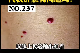 皮肤长小红点，是不是肝脏有问题？#樱桃状血管瘤 #红痣 视频封面