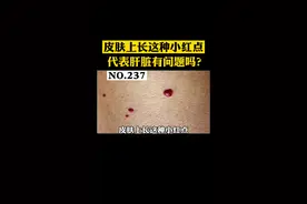 皮肤长小红点，是不是肝脏有问题？#樱桃状血管瘤 #红痣 视频封面
