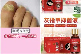 阿莫洛芬擦剂【灰趾甲专用】抑菌液祛坏甲灰钾液不伤好甲手脚指甲视频封面