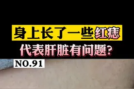 身上长凸起的小#红痣 ，就代表肝脏不好或者是#健康 有问题吗？#樱桃状血管瘤 #朱砂痣 #医学科普 视频封面