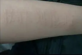 #皮肤划痕症 怎么办？#人工性荨麻疹视频封面