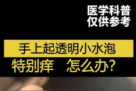 手上起透明小水泡，特别痒，怎么办？#汗疱疹 #科普 @抖音短视频 视频封面