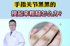 手指关节黑黑的，看起来很粗糙，试试这个方法#医学科普  #皮肤视频封面