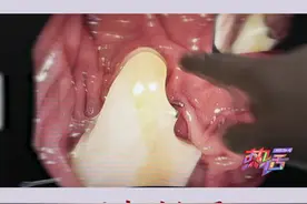 假牙吞进肚子该怎么办？千万别大意！可能有生命危险！视频封面