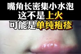 嘴巴周围长密集的小水泡，这可不是#上火 ，很可能是#病毒 感染#科普 视频封面
