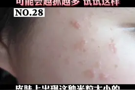 脸上长米粒大小的肤色或褐色扁平小疙瘩，这是#扁平疣 #医学科普 #皮肤 不要用手去抓，可能会越抓越大多视频封面