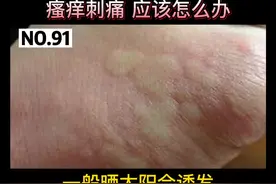 晒太阳以后起风团，瘙痒刺痛#科普 #夏天视频封面