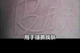 用手搔抓皮肤，就会出现红色的划痕，特别烦人，那怎么办呢？#医学科普 #皮肤 #科普 视频封面