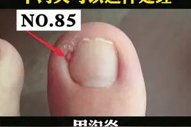 指甲周围红肿疼痛，走起路来很痛苦，这是#甲沟 炎，我们可以分情况这样处理#健康 #科普 #皮肤 #指甲 视频封面