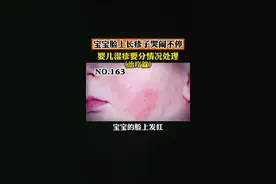 宝宝脸上起疹子，又哭又闹的，看着很心疼，看皮肤科医生如何治疗#婴儿湿疹 #湿疹 #孩子健康 #医学科普 视频封面