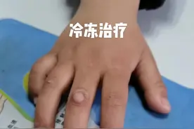 冷冻治疗病毒疣 #医学科普 #液氮冷冻 #寻常疣视频封面