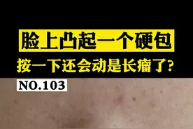 #表皮样囊肿 脸上长硬包，不痛不痒，按一按还会动，是长瘤了？#科普 #皮肤 视频封面
