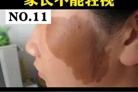 儿童出现咖啡斑，家长要重视#咖啡斑 #小孩 视频封面