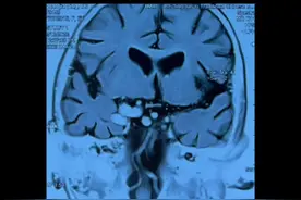 患者女性，6岁，发作性右眼视物模糊，这是啥病？#医学影像视频封面