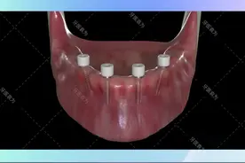 半口缺牙是怎么用4颗种植体恢复的？一起看看吧#健康真相官 #口腔科普 视频封面