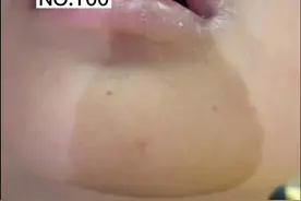 孩子脸上出现#咖啡斑 ，看看还有没有同时出现这些情况#科普视频封面