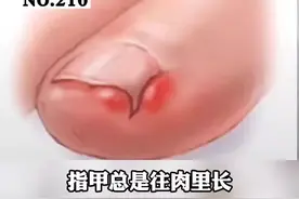 脚趾甲总往肉里长，忍痛剪了又长回去，疼的怀疑人生，那可能是你没做对这一步#涨知识 #剪指甲 #指甲 #嵌甲 视频封面