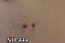 #痣 上长了毛毛是好事还是坏事？这个视频告诉你#医学科普 视频封面
