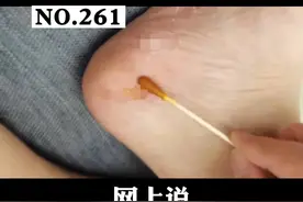 #碘伏 可以治疗#脚气 ？是真的吗？#医学科普 #科普 #皮肤 #健康 视频封面