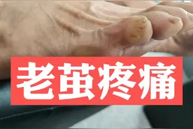 脚上长老茧，疼，为什么，怎么办#dou出新知 #老茧 #脚疼视频封面
